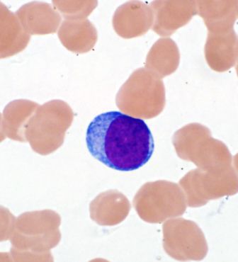 Peripheral blood: Circulating blast morphology